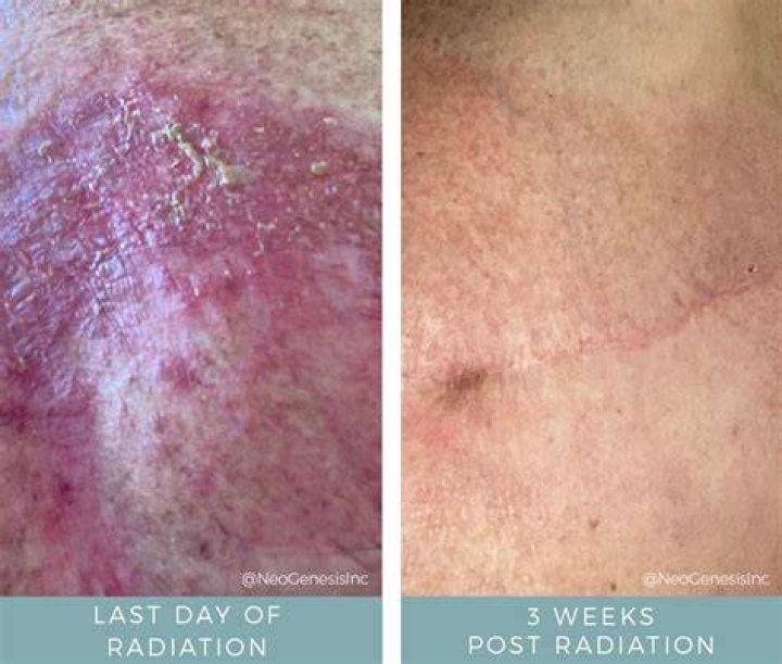 83 days of radiation with Hisashi Ouchi...!!