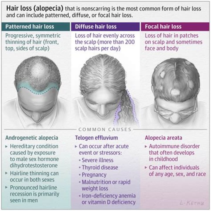 Alopecia Areata Hair Loss Causes, Symptoms, & Treatments