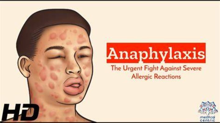 Anaphylactic shock News Dentagama