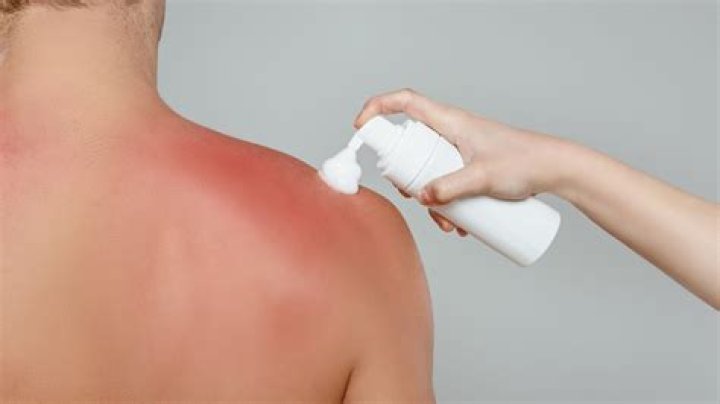 Can You Really Use Shaving Cream To Treat A Sunburn?