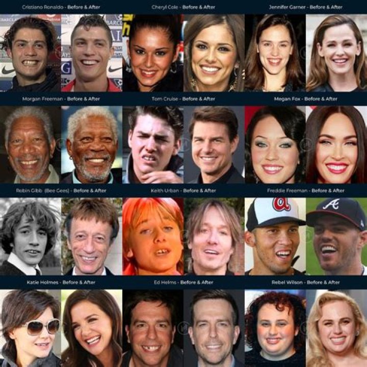 Celebrities That Have Had Composite Bonding & Veneers