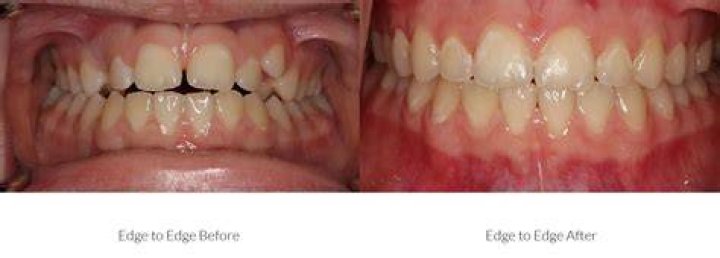 Edge before and after