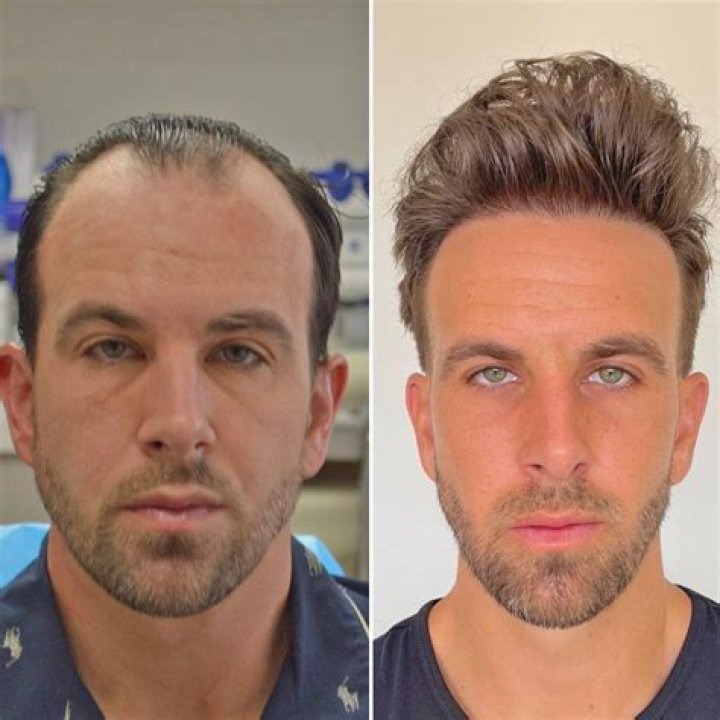 Hair Transplant Before/After Results for Men Bosley Hair Transplant