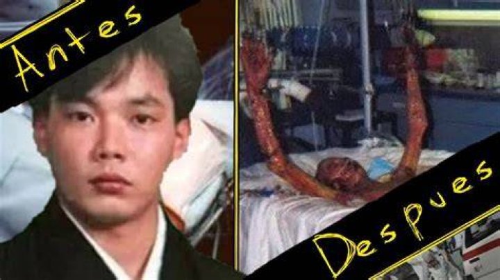 Hisashi Ouchi Real Photos Hospital Unveiling a Tragic Medical Case