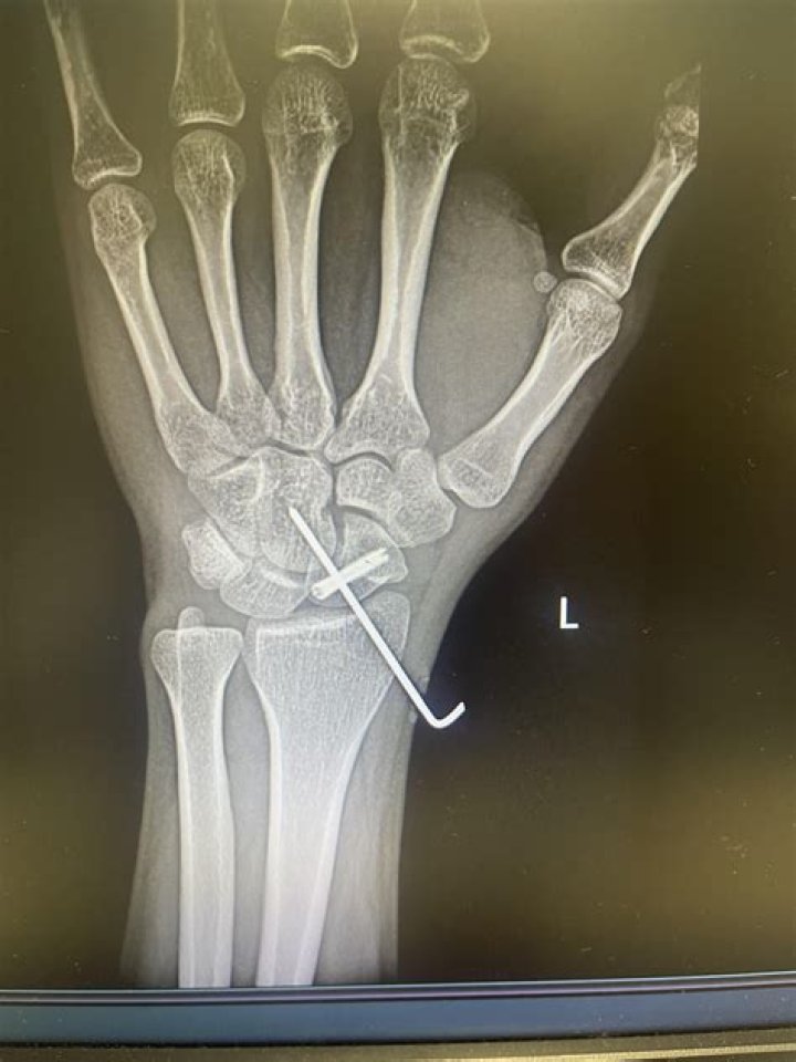 “I Don’t Like Hospitals & Needles”: Daniel Ricciardo Spills Truth on His Broken
Hand Surgery