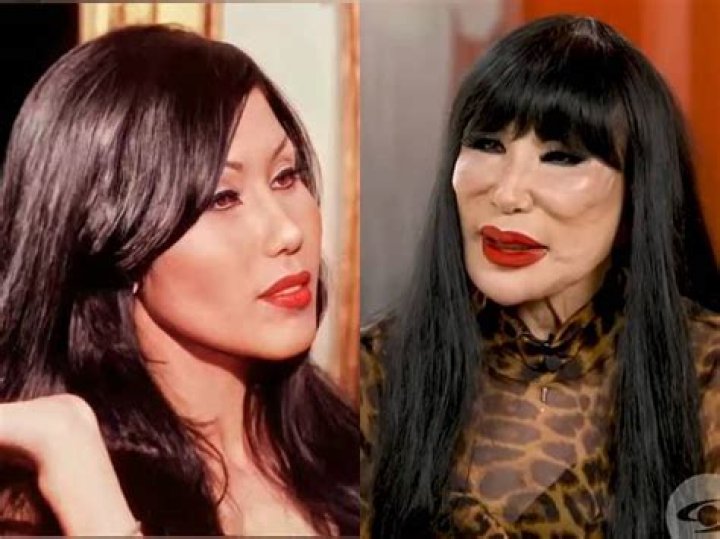 Lyn May's Plastic Surgery Destroyed Her Face What Exactly Went Wrong?