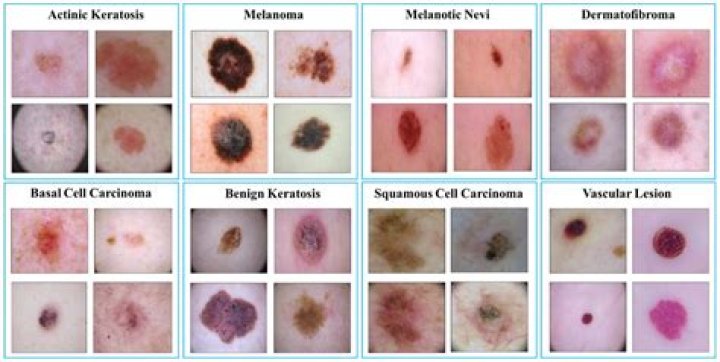 Melanoma and NMSC are closely linked to exposure to ultraviolet radiation (UV) from either the sun or tanning beds. Photo / 123RF