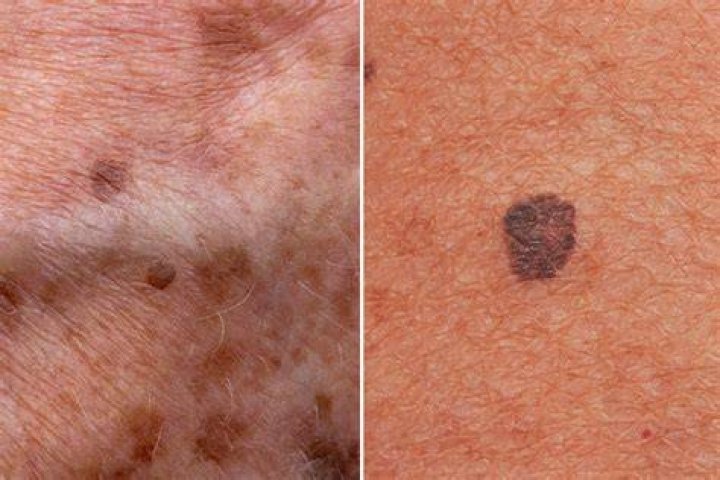 Melanomas occur as a consequence of cancer-activating mutations in a skin cell called a melanocyte. Photo / Getty Images