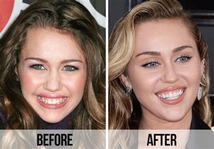 Miley Cyrus Clear Braces NatasjaJiri
