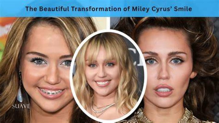 Miley Cyrus: The Transformation Of Her Smile With Teeth Veneers