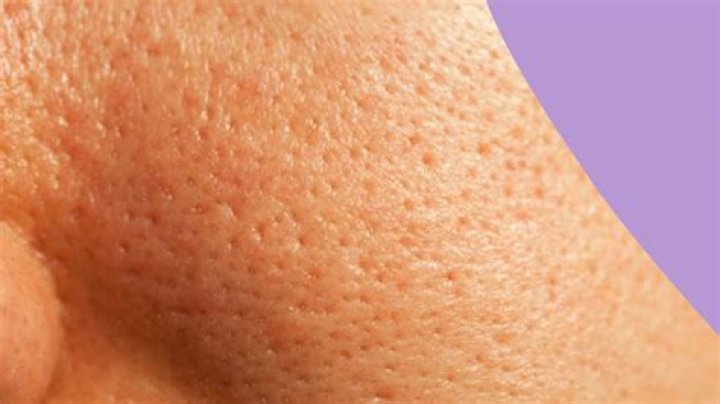 Nick Austin Blackheads, Get rid of blackheads, Pretty celebrities