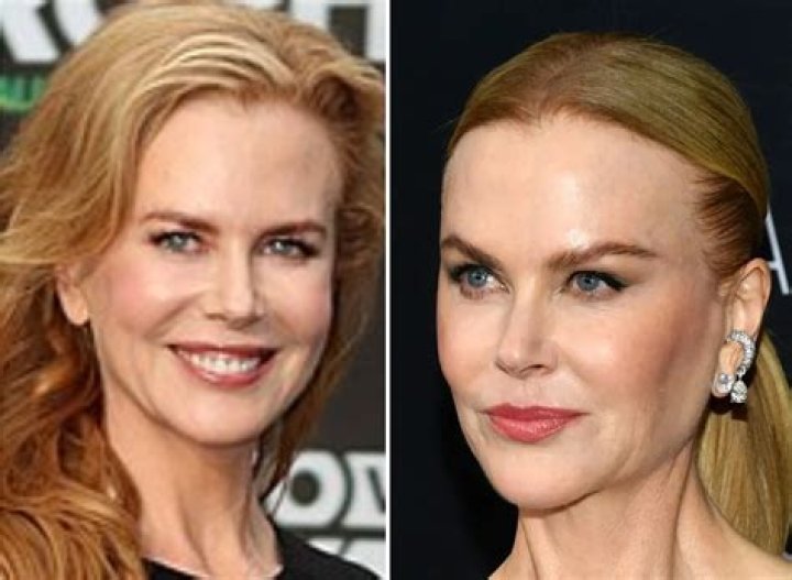 Nicole Kidman Plastic Surgery: A Comprehensive Analysis