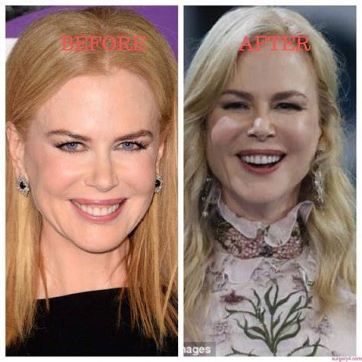 Nicole Kidman Plastic Surgery Photos [Before & After] ⋆ Surgery4
