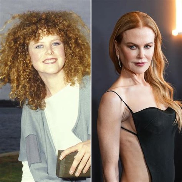 Nicole Kidman&rsquo;s Plastic Surgery Transformation Top Docs Claim