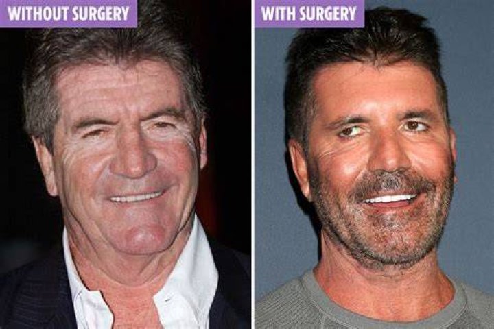 Simon Cowell has had surgery after breaking his back. Photo / AP