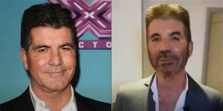 Simon Cowell is done with Botox and fillers in his face
