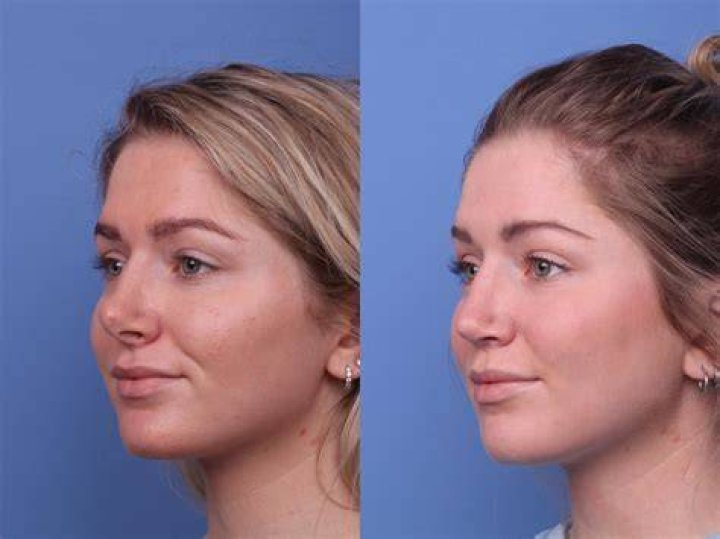 Suni Lee Before And After Plastic Surgery: A Complete Insight