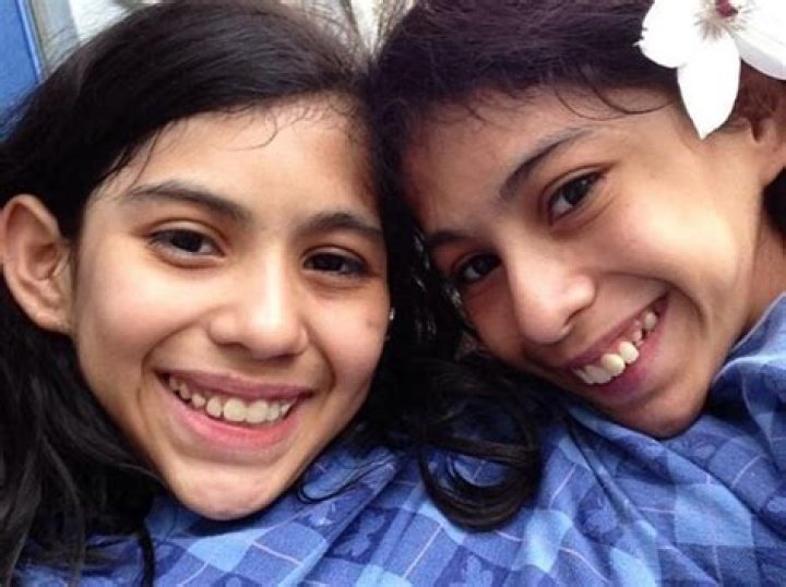 The extraordinary life of conjoined twins who refuse to be separated