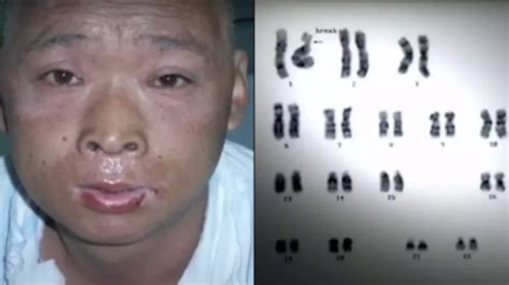 Understanding Hisashi Ouchi's Skin Condition: A Comprehensive Overview