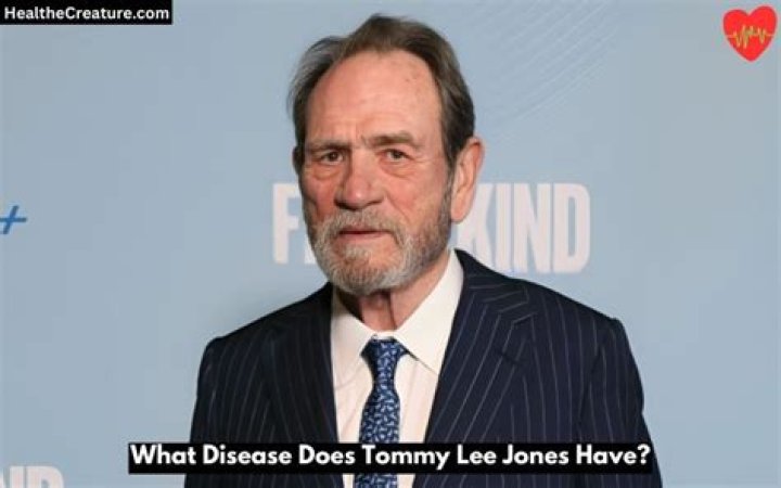 What Disease Does Tommy Lee Jones Have? Exploring The Truth Top Globe