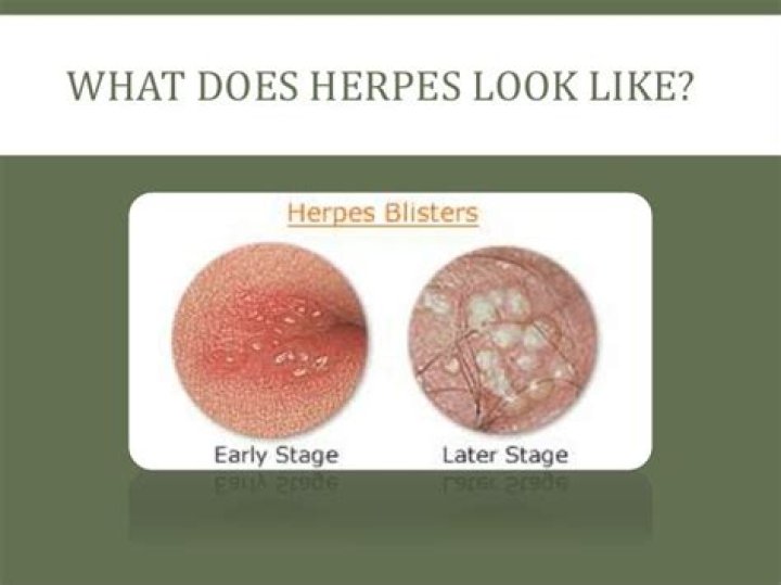 What Does Herpes Look Like On A Man Lips