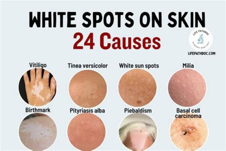 What Does It Mean If You Have White Spots On Your Skin?