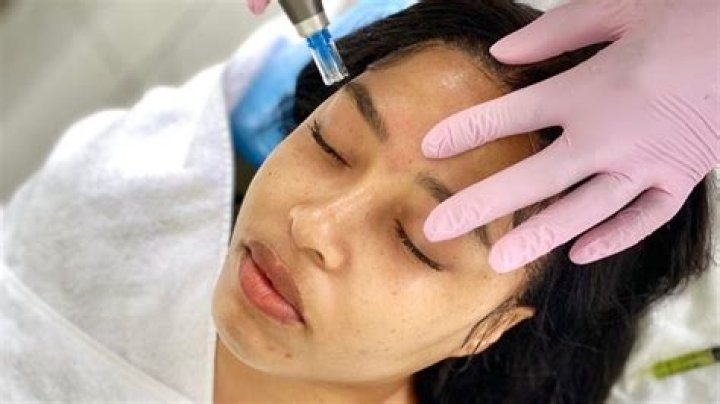 Why You Should Avoid Retinol And Other Active Ingredients After Microneedling