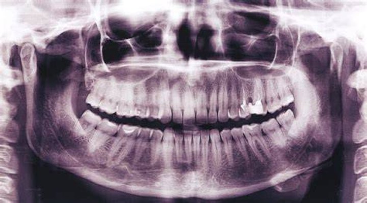 X-rays show the the extensive operations Aletta Langeveldt underwent following her fall at North Shore Hospital. Photo / Supplied.